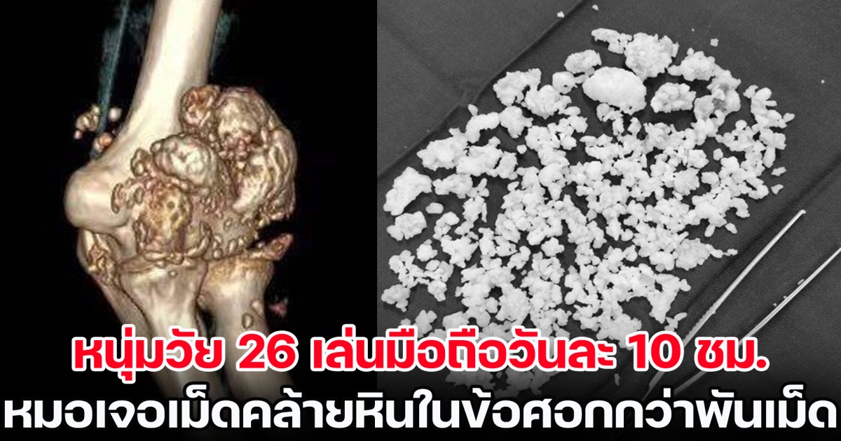 อุทาหรณ์! หนุ่มวัย 26 เล่นมือถือวันละ 10 ชม. จู่ ๆ งอข้อศอกไม่ได้ ไปหาหมอเจอเม็ดคล้ายหินกว่าพันเม็ด (ข่าวต่างประเทศ)