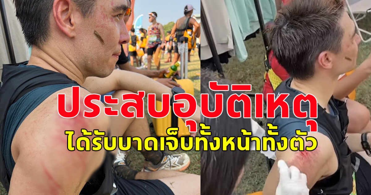 แห่เป็นห่วง แมทธิว ประสบอุบัติเหตุ ขณะไปวิ่งเทรล ได้รับบาดเจ็บทั้งหน้าทั้งตัว