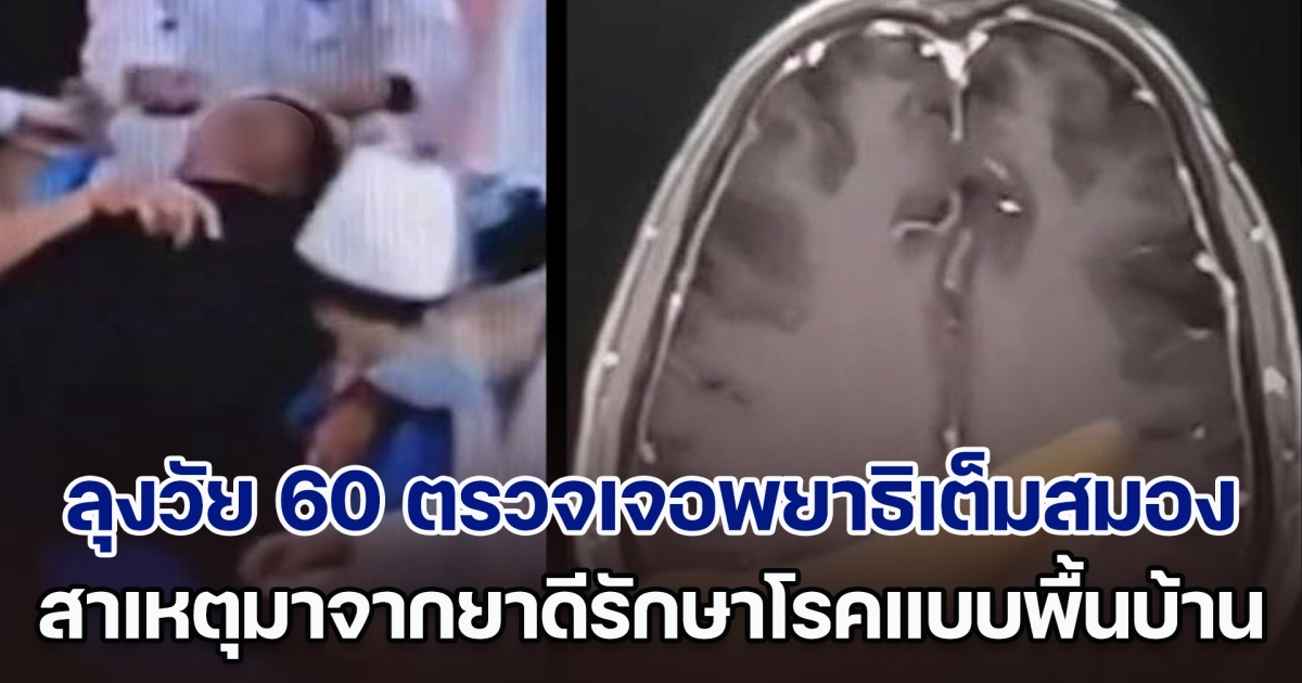 ลุงวัย 60 ล้มหมดสติกลางบ้าน หมอตรวจเจอพยาธิเต็มสมอง สาเหตุมาจากยาดีรักษาโรคแบบพื้นบ้าน (ตปท.)