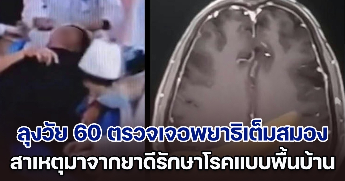 ลุงวัย 60 ล้มหมดสติกลางบ้าน หมอตรวจเจอพยาธิเต็มสมอง สาเหตุมาจากยาดีรักษาโรคแบบพื้นบ้าน (ตปท.)