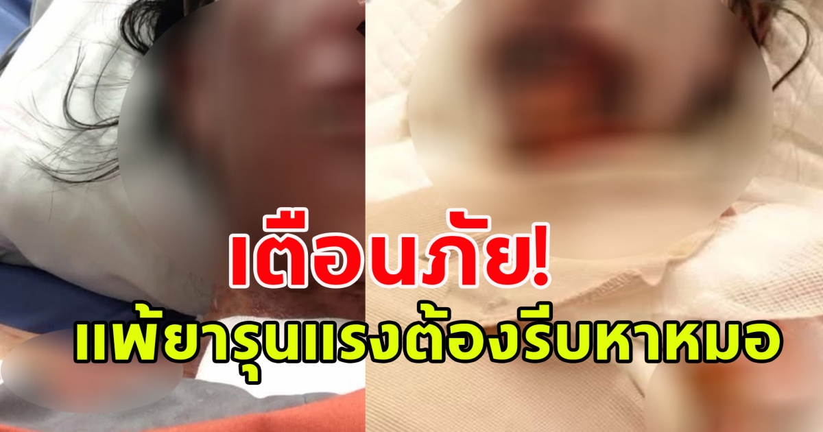 เตือนภัย! แพ้ยารุนแรงต้องรีบหาหมอ หนักสุดเสียชีวิตได้