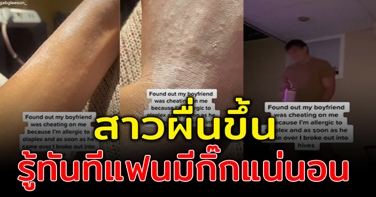 สาวโพสต์คลิป อ้างจับได้แฟนหนุ่มนอกใจ เพราะอาการแพ้ที่แขน