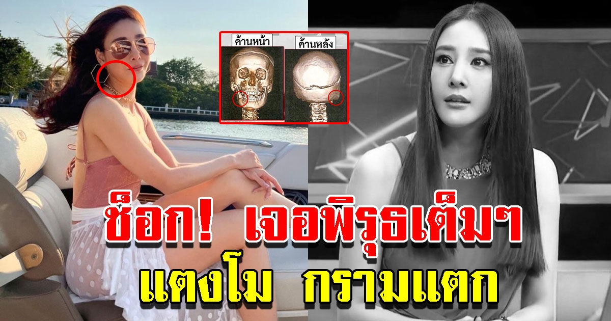 หมอเจอพิรุธ กรามแตงโมแตก หลังเต้งัดหลักฐานโชว์