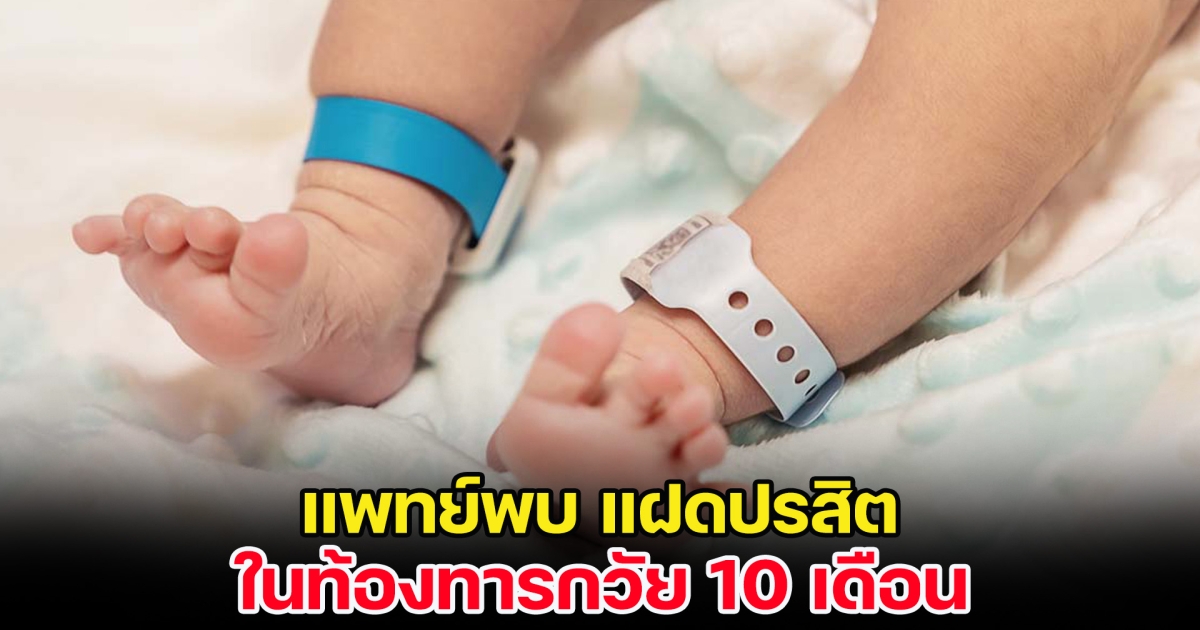 หนึ่งในล้าน ทารกวัย 10 เดือน ปวดท้องไม่รู้สาเหตุ พอไปผ่าตัดเจอ คู่แฝด แฝงร่างอยู่ในท้อง